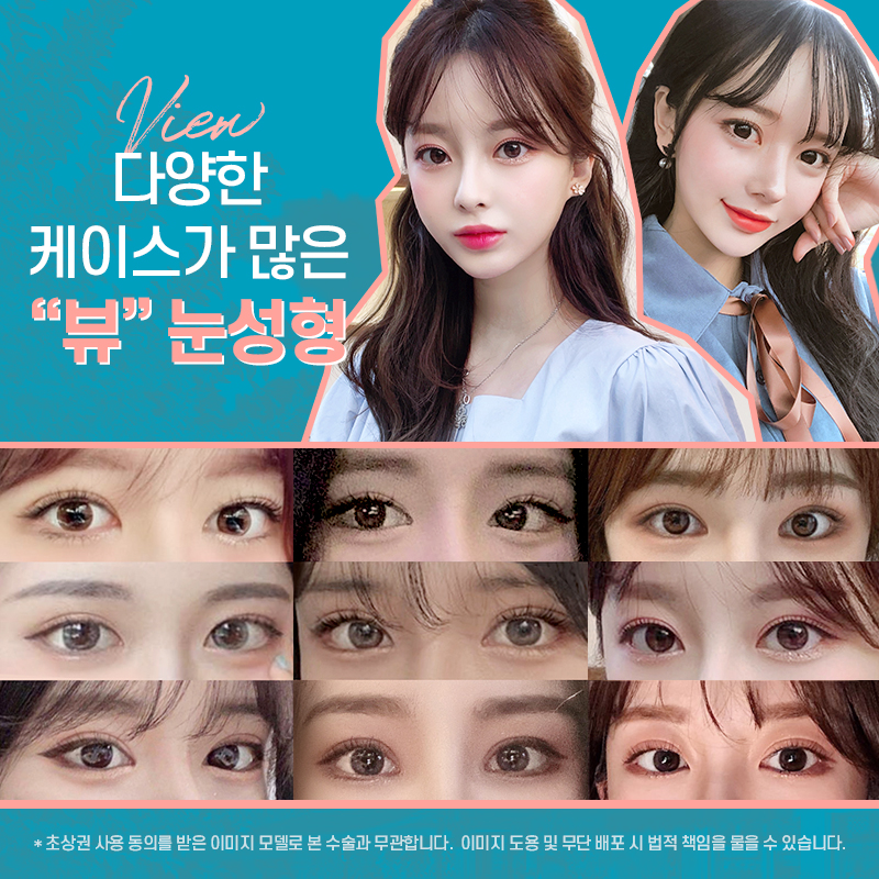 쌍꺼풀재수술비용 높은 난이도이므로 관련 이미지 4