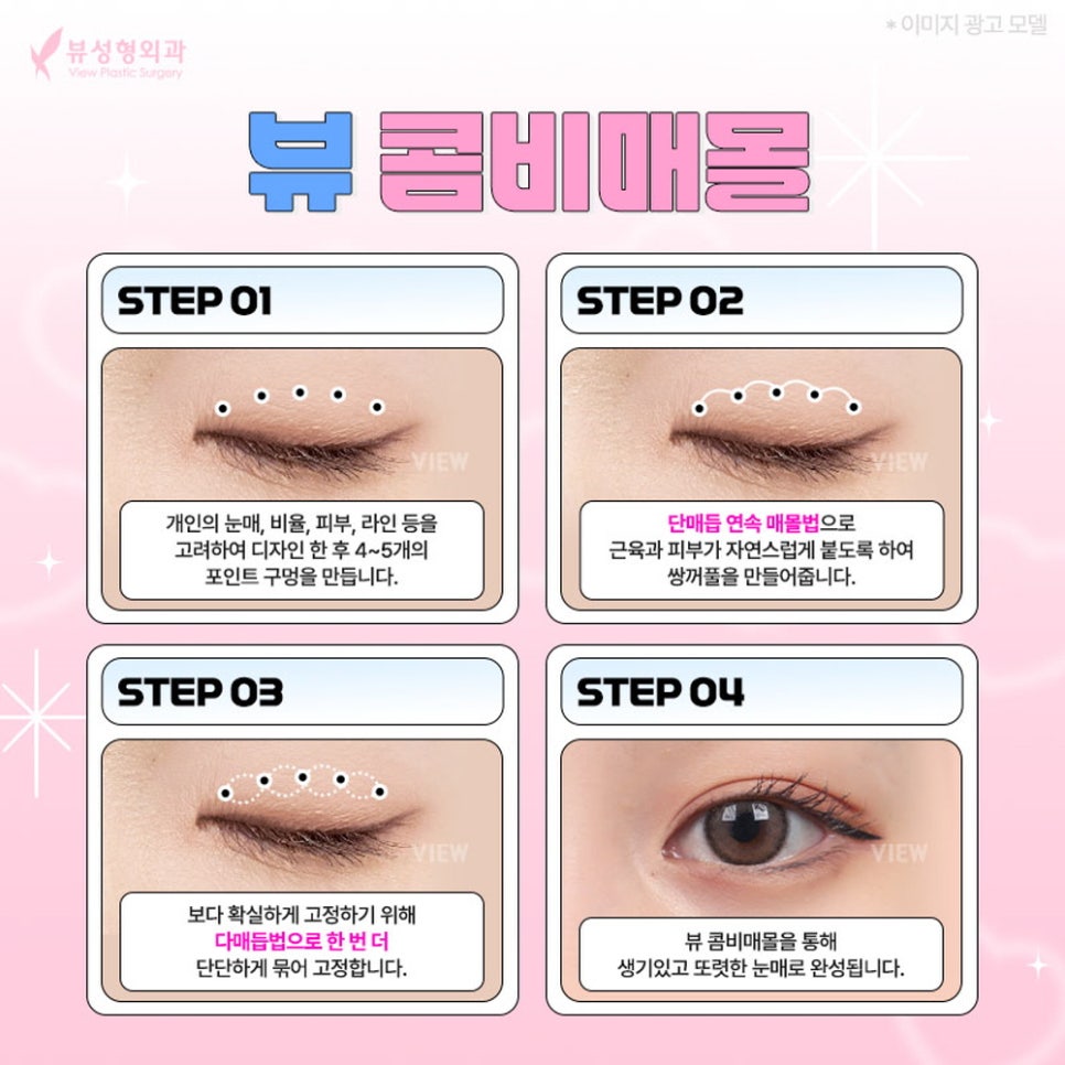 내게 맞는 눈성형 알아보기 관련 이미지 5