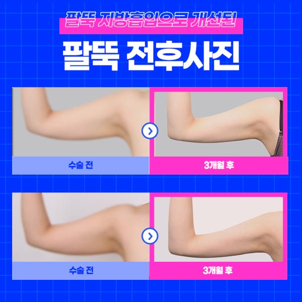 팔뚝살지방흡입 자연스럽고 조화로운 팔뚝을 원한다면 관련 이미지 3