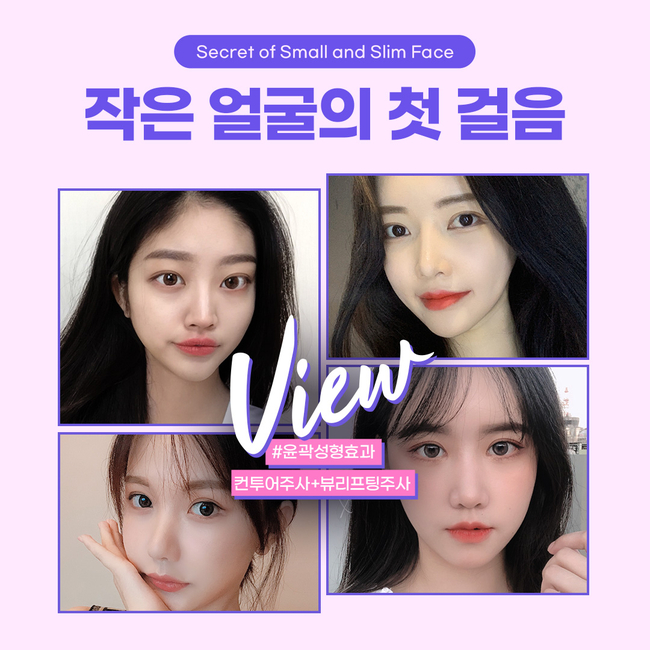 윤곽주사 후기 갸름하게 변화된 비결은 뷰성형외과 관련 이미지 7