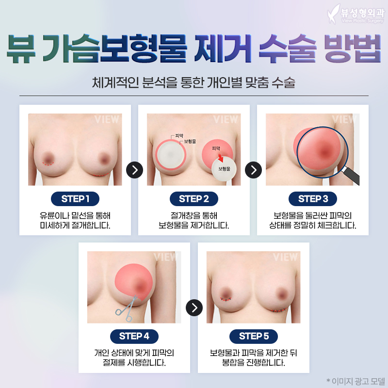 가슴재수술, 이런 케이스는 피막 제거 필수 ✨ 관련 이미지 2