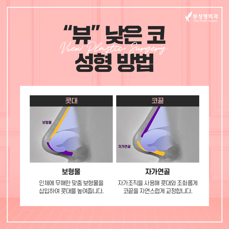 코성형, 개인별 유형에 적합한 수술방법은? 관련 이미지 10