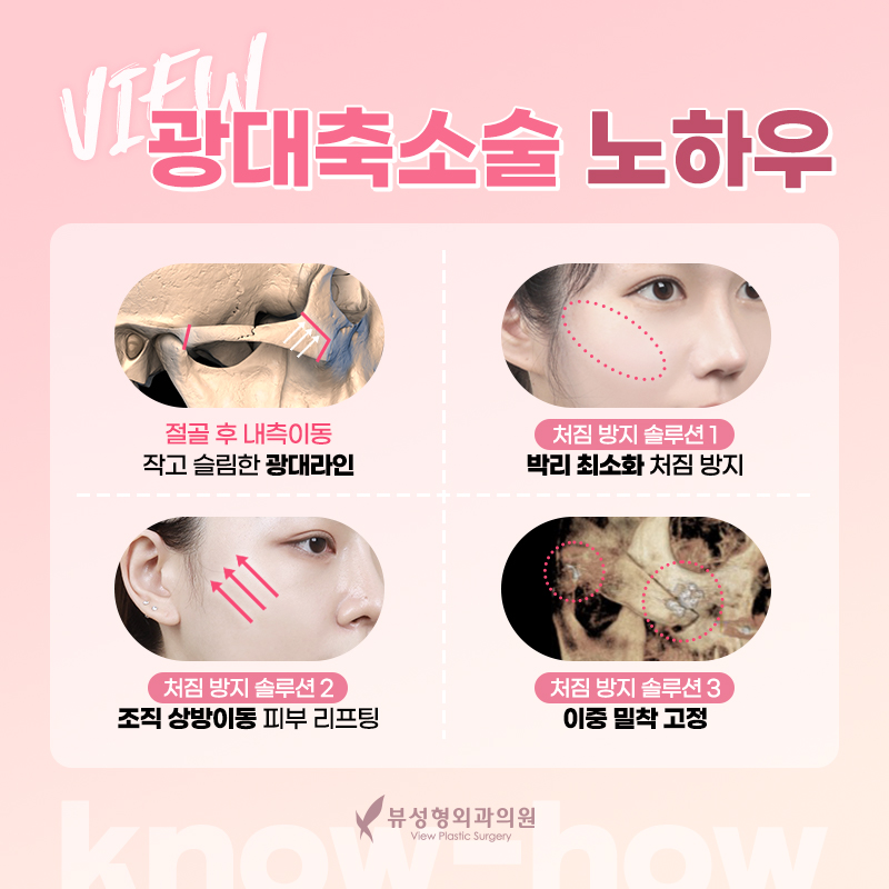 안면윤곽가격 정확히 알아보려면? 관련 이미지 4