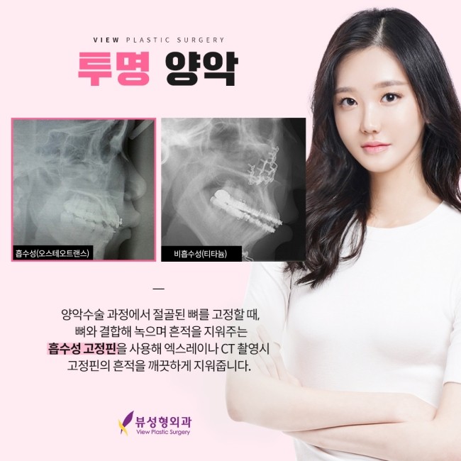예뻐지는 수술? 양악수술의 올바른 정보 관련 이미지 8
