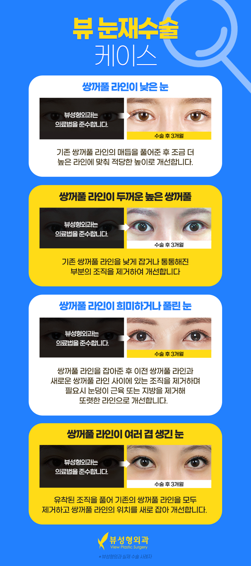 눈재수술유명한곳, 뷰성형외과 관련 이미지 4