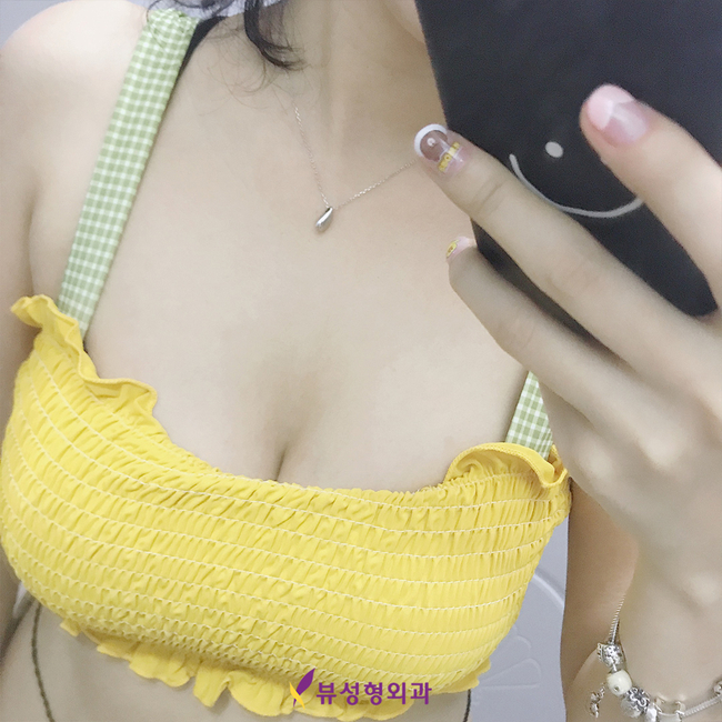 가슴수술 후 달라진 볼륨자신감으로 당당해지자 관련 이미지 5