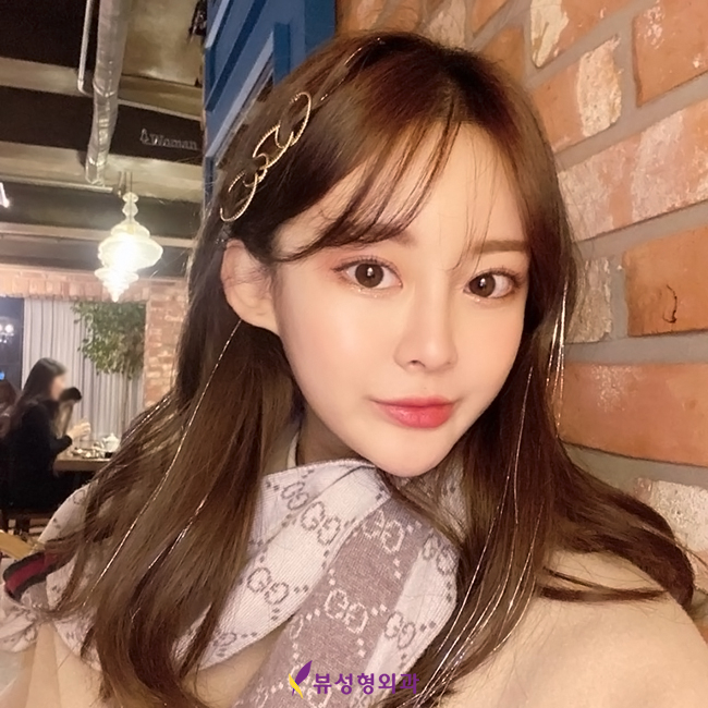 뷰성형외과 트임성형수술로 예쁨 충전 완료&hearts; 관련 이미지 2