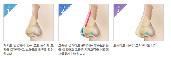 코성형, 개인별 유형에 적합한 수술방법은? 관련 이미지 4