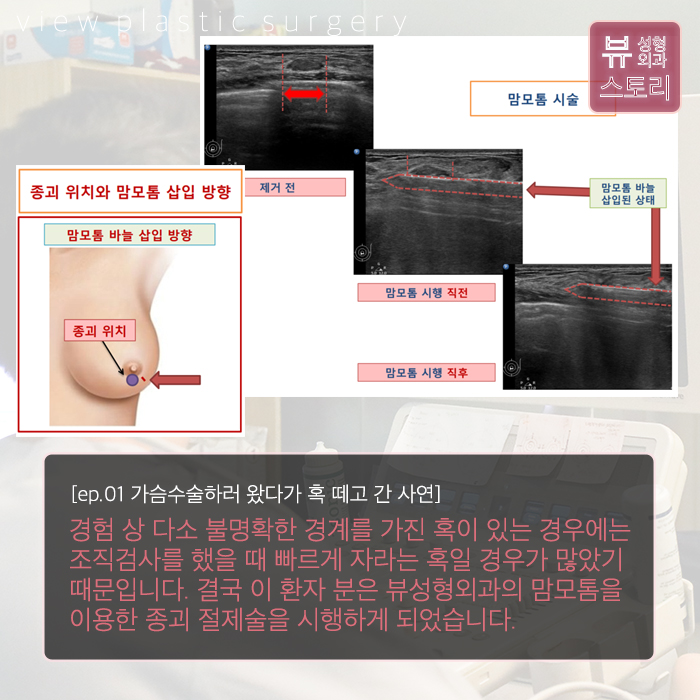 <VIEW Ep.01> 가슴수술하러 왔다가 혹떼고 간 사례 관련 이미지 5