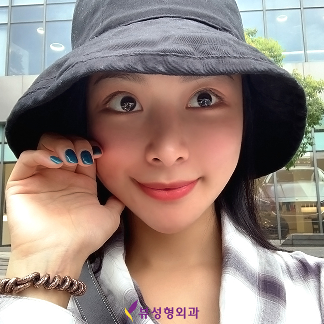 눈매를 시원하게! 뷰성형외과 트임수술 관련 이미지 4