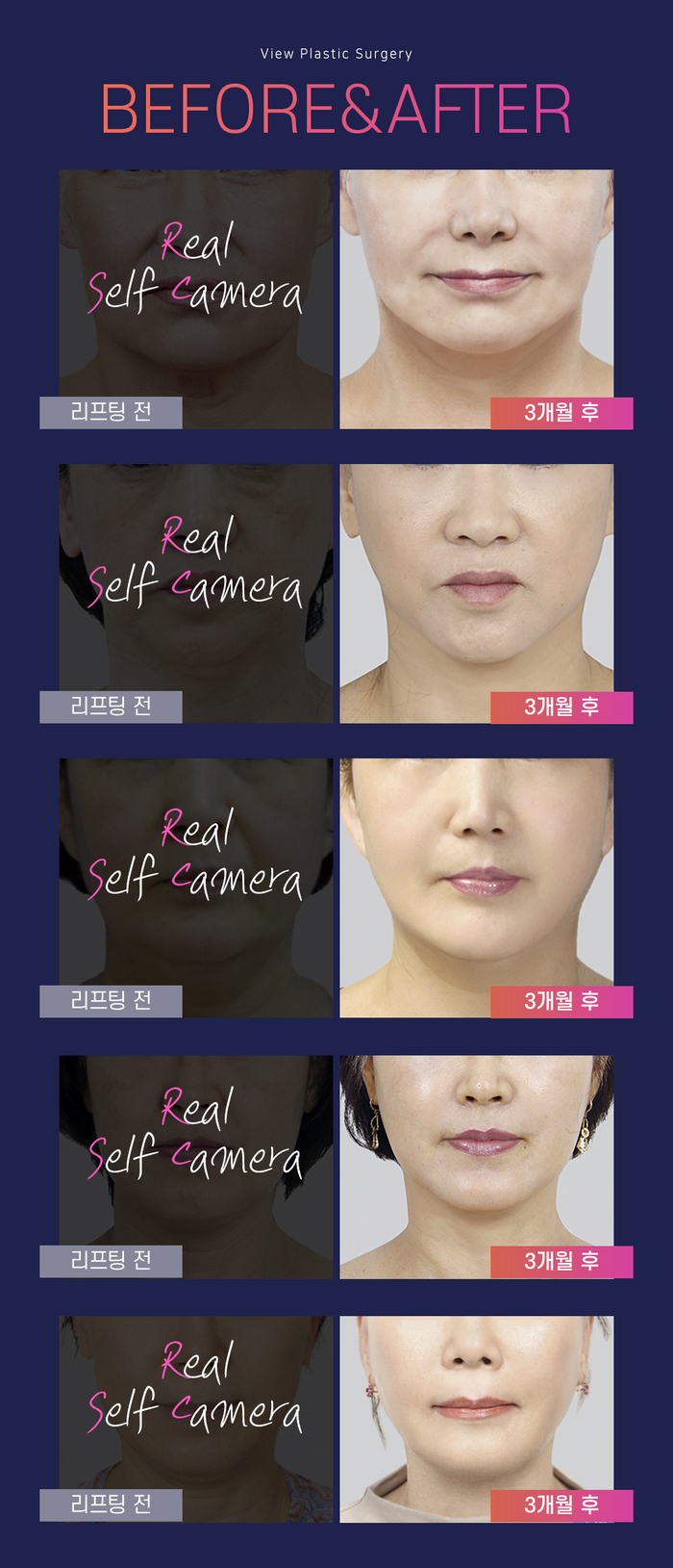 실리프팅 VS 안면거상술, 피부 상태에 맞는 맞춤리프팅 관련 이미지 10