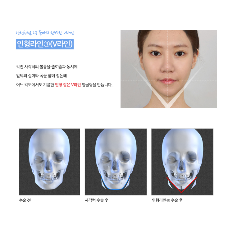 VIEW만의 윤곽성형 알아보기 관련 이미지 2