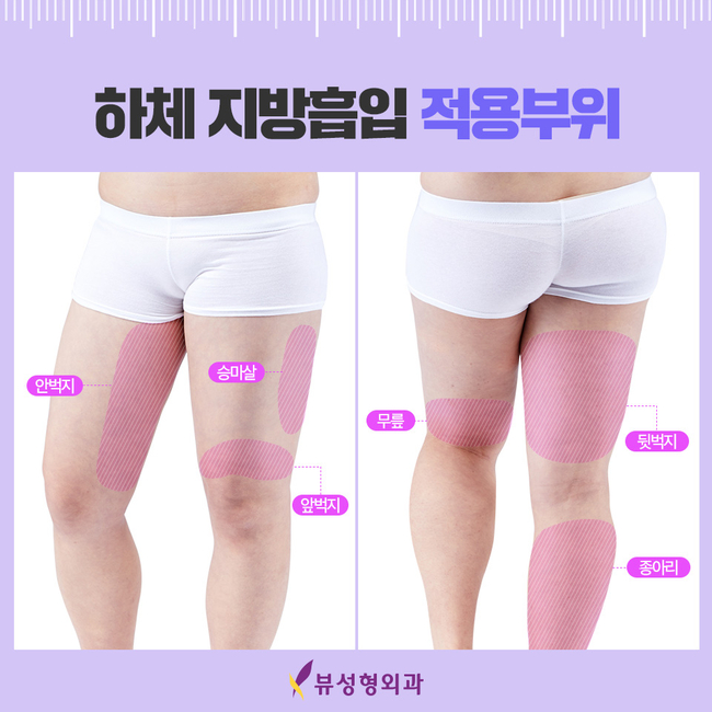 지방흡입수술로 워너비 몸매 만들어봐요~ 관련 이미지 4