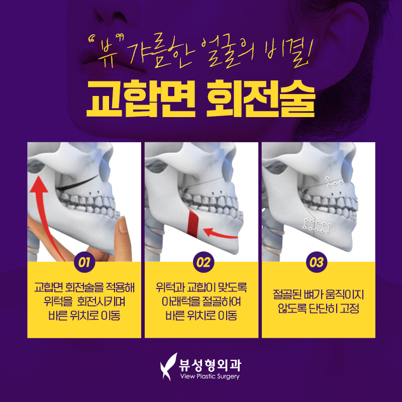 예뻐지는 수술? 양악수술의 올바른 정보 관련 이미지 5