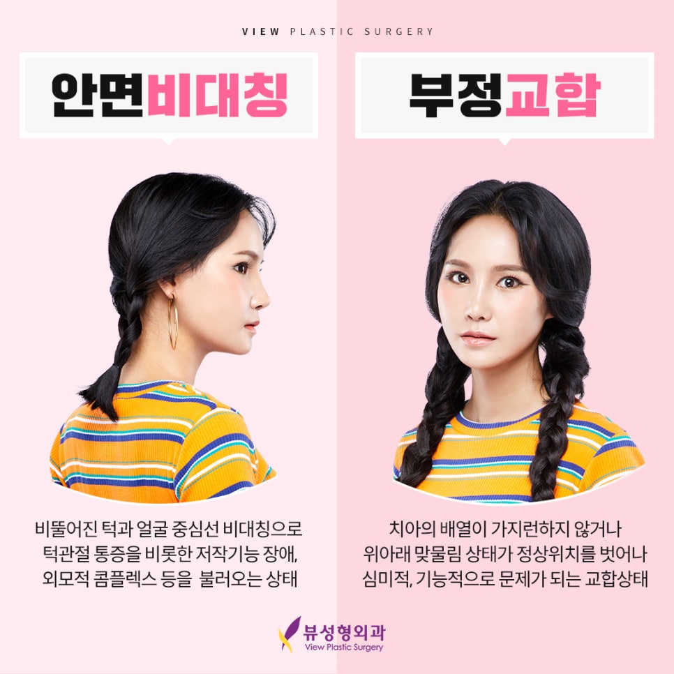 예뻐지는 수술? 양악수술의 올바른 정보 관련 이미지 3