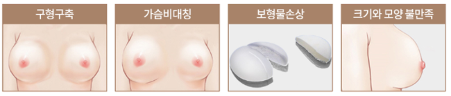 자연스런 가슴성형, 본인에게 적합한 보형물 및 절개방법 선택 중요 관련 이미지 11