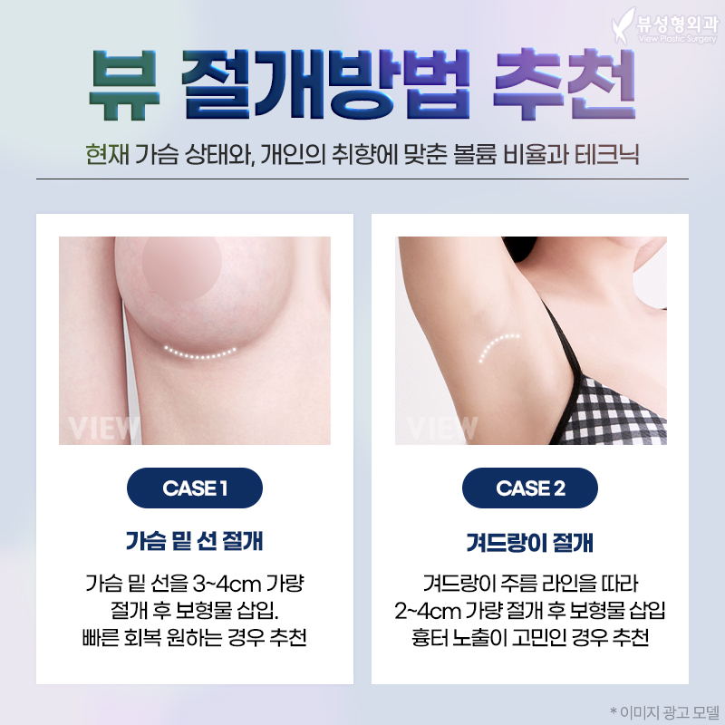 가슴성형 모양과 촉감은 기본, 안전은 필수! 관련 이미지 11