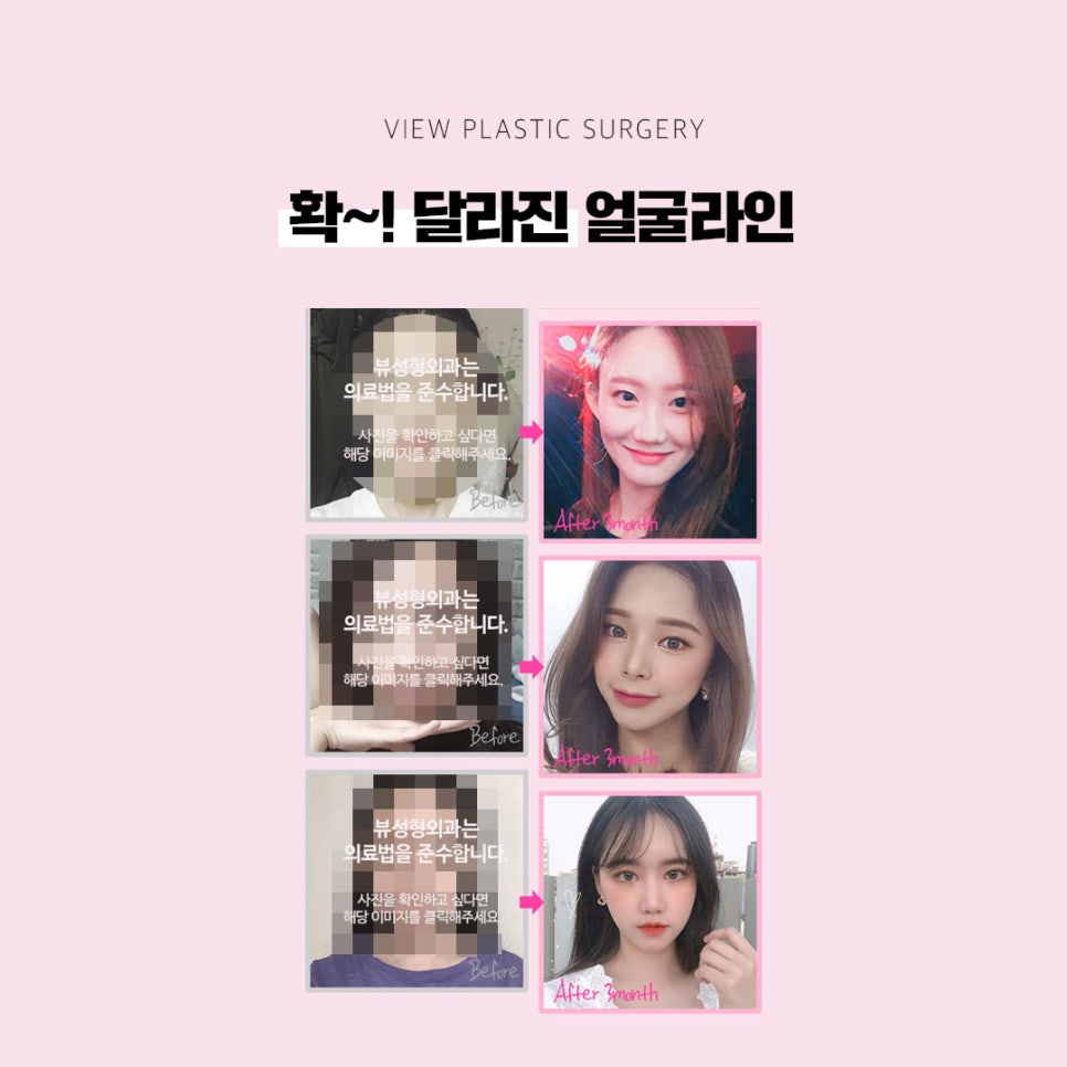 안면윤곽수술회복기간 제대로 알아보자 관련 이미지 4