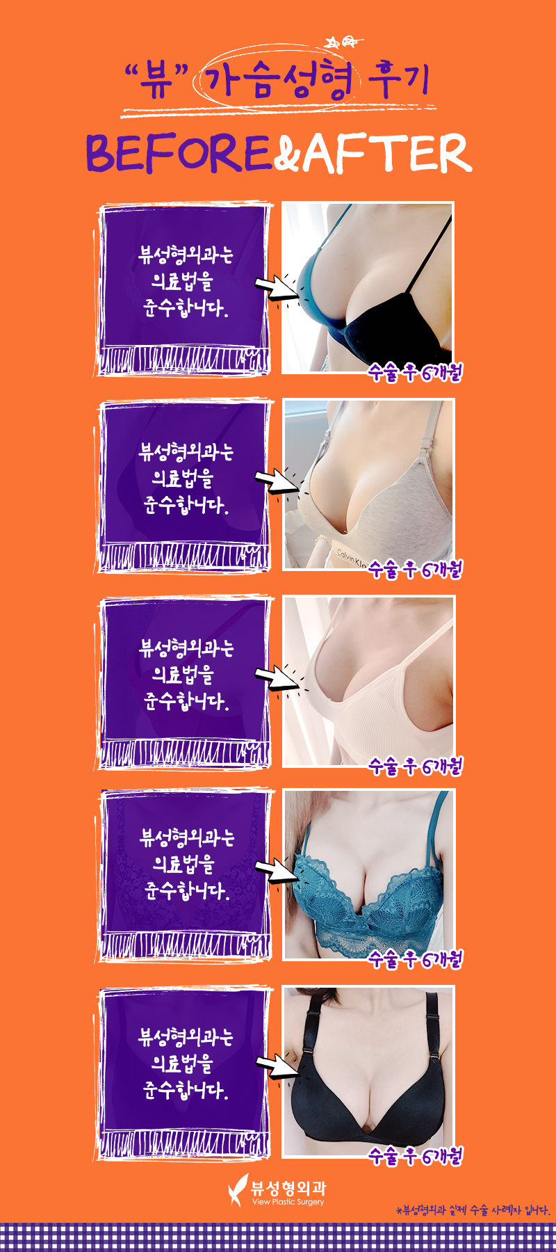 모티바가슴성형가격 실력을 갖춘 곳에서 관련 이미지 2