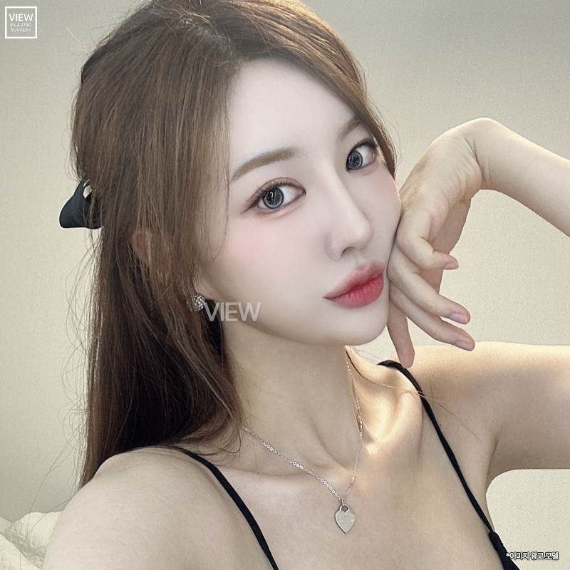 뒤트임후기 비교해서 나만의 매력적인 눈매 찾기👀💜 관련 이미지 7