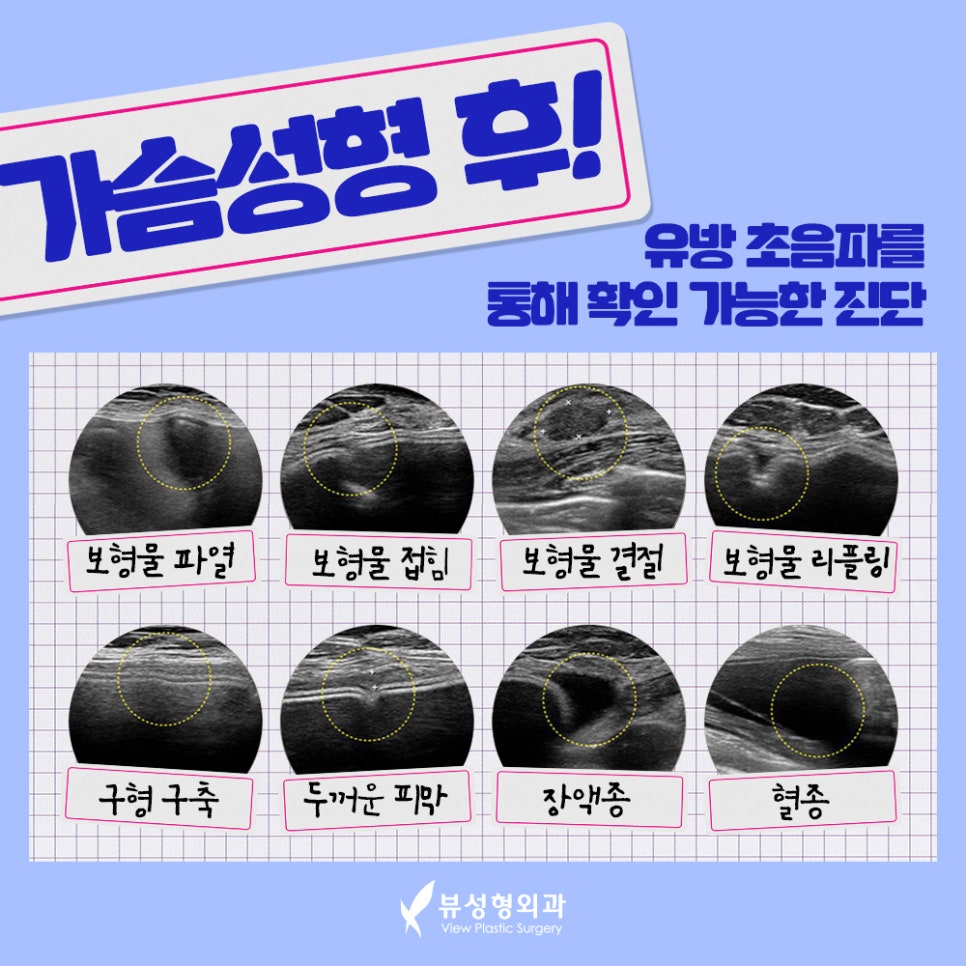 가슴확대수술, 효율성까지 따져서 관련 이미지 5