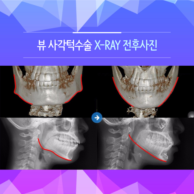 안면윤곽성형으로 이미지를 바꿔볼까? 관련 이미지 4