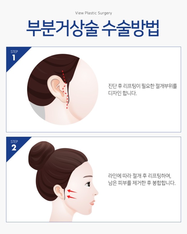 실리프팅 VS 안면거상술, 피부 상태에 맞는 맞춤리프팅 관련 이미지 14