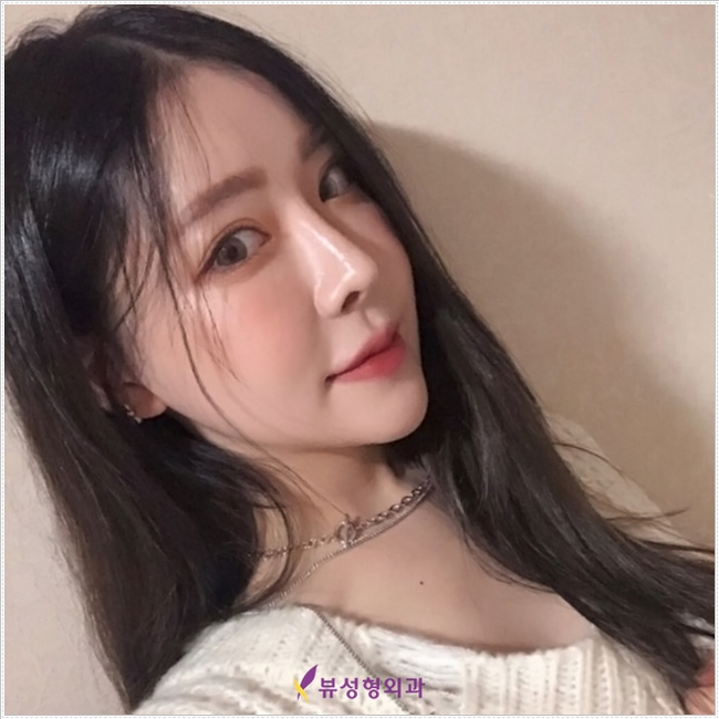 더 이상의 실패 없는, 뷰성형외과 코재수술 관련 이미지 6