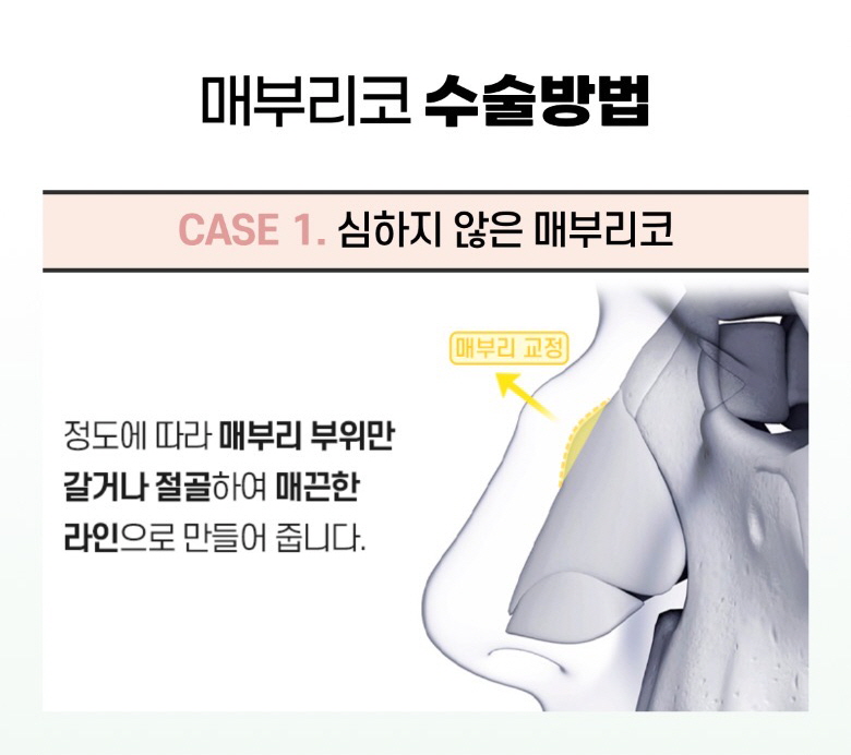 울퉁불퉁한 콧대를 매끈하게, 뷰성형외과 매부리코성형 관련 이미지 7