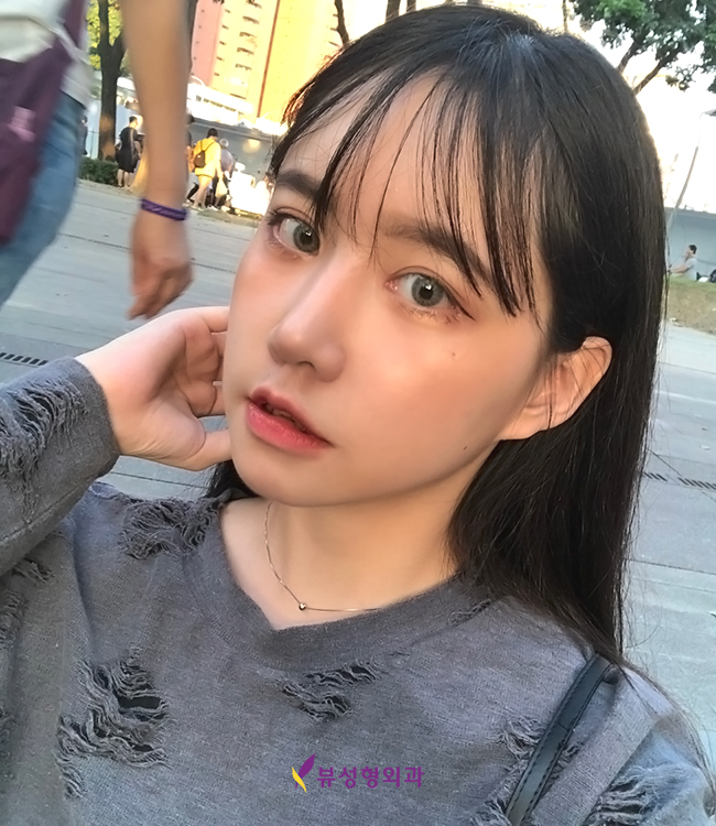 눈매를 시원하게! 뷰성형외과 트임수술 관련 이미지 1