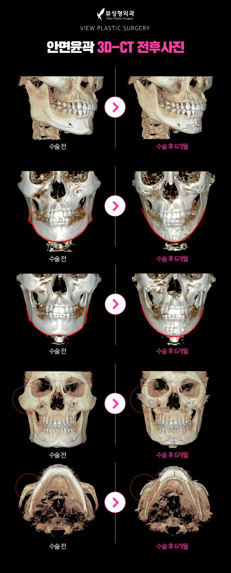안면윤곽후기, 붓기는 얼마나 갈까? 관련 이미지 5