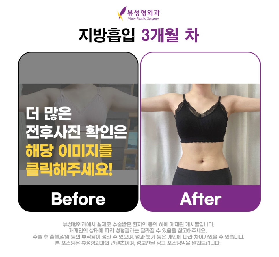 여자다이어트 스트레스 그만! +전후사진 관련 이미지 4