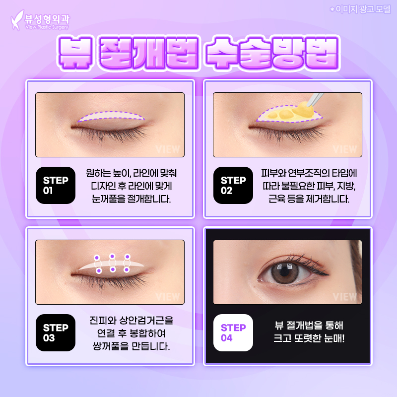 내게 맞는 눈성형 알아보기 관련 이미지 4