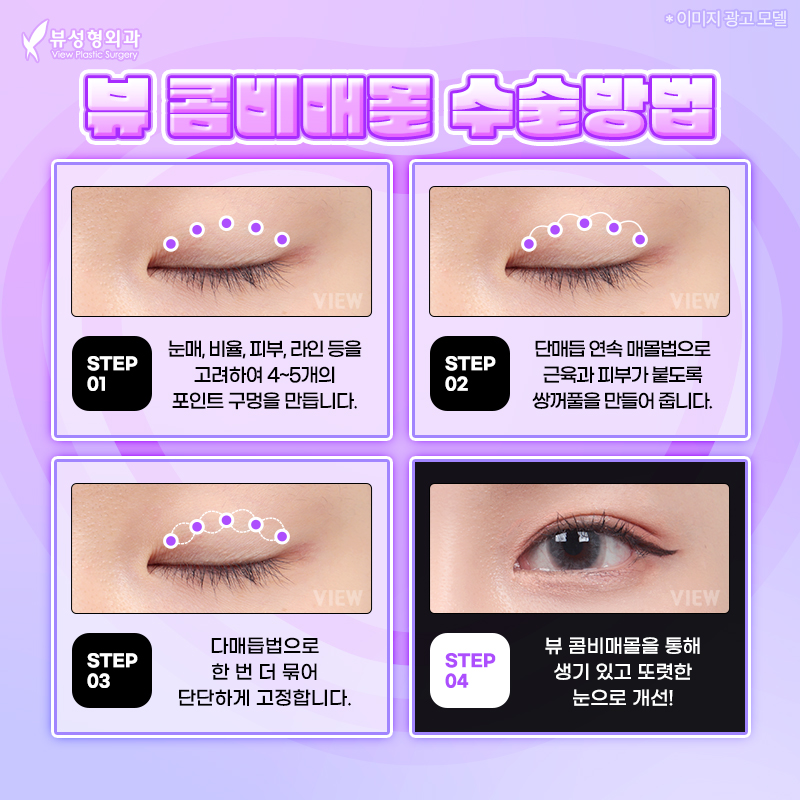 내게 맞는 눈성형 알아보기 관련 이미지 6