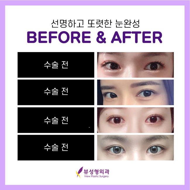 매몰법잘하는곳 뷰성형외과 콤비매몰이라면 관련 이미지 10