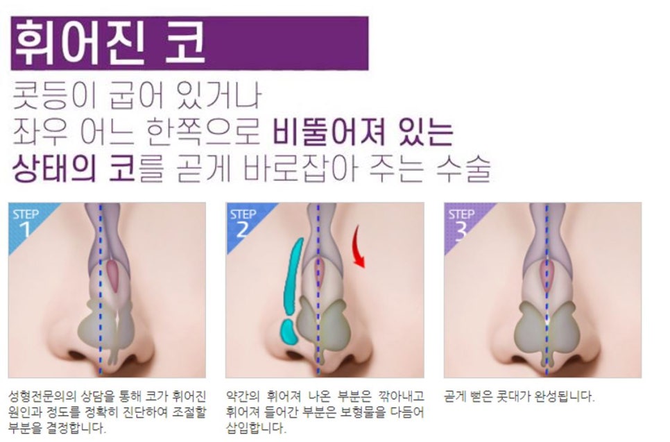 코성형, 개인별 유형에 적합한 수술방법은? 관련 이미지 7