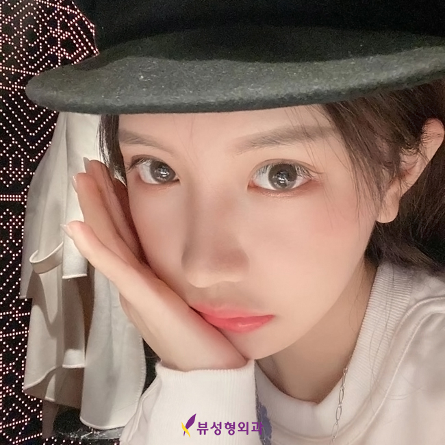 뷰성형외과 트임성형수술로 예쁨 충전 완료&hearts; 관련 이미지 1