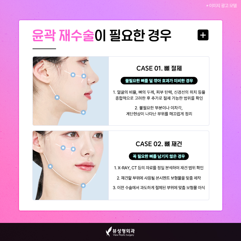 광대재수술, 결과를 바꾸는 건 따로 있습니다 관련 이미지 2