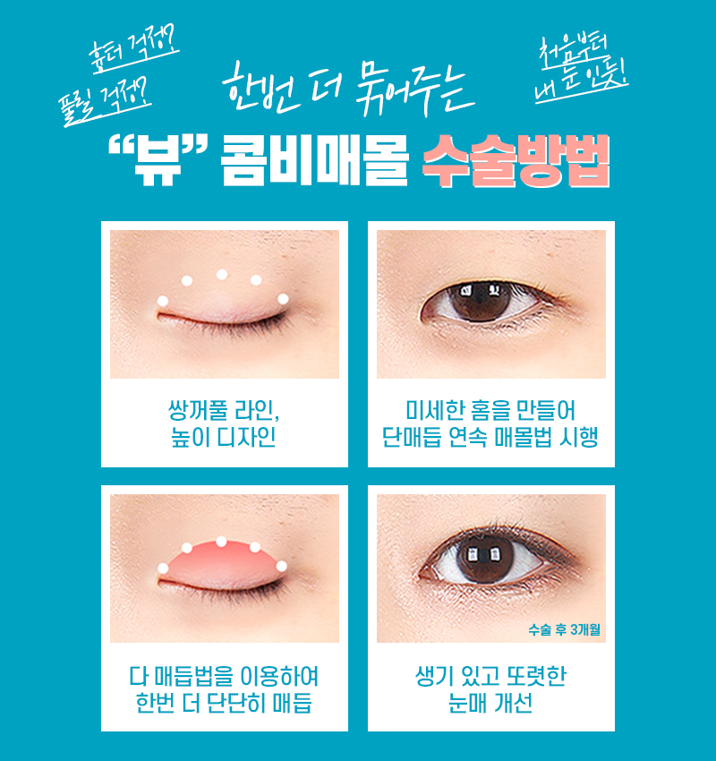 내게 맞는 눈성형을 위한 수술방법 알아보기 관련 이미지 5