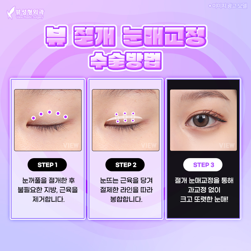 내게 맞는 눈성형 알아보기 관련 이미지 14