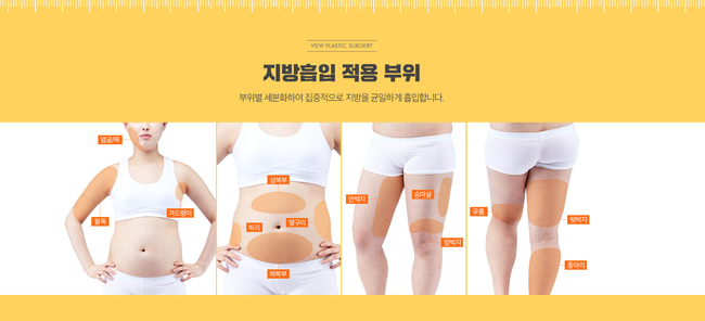 &hearts; 뷰성형외과 지방흡입 프로모션 OPEN&hearts; 관련 이미지 8