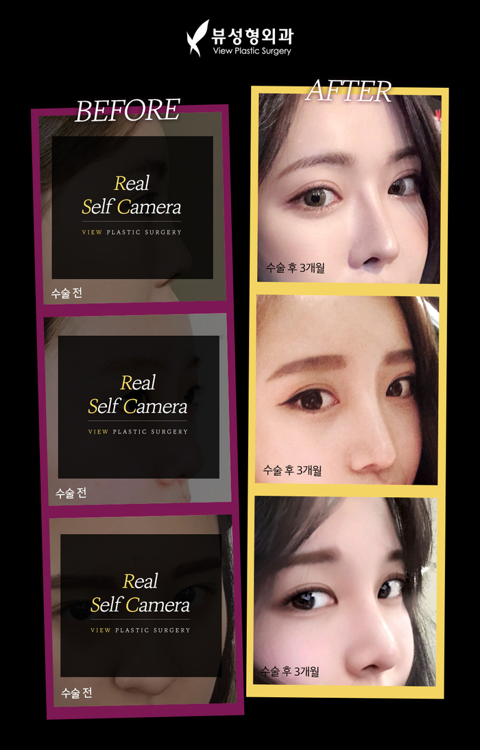 얼굴의 비율과 균형, 조화를 이루는 코성형 관련 이미지 10