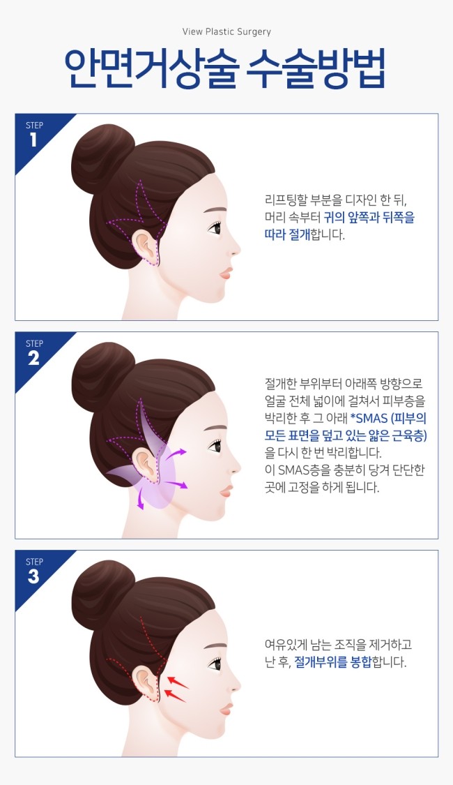실리프팅 VS 안면거상술, 피부 상태에 맞는 맞춤리프팅 관련 이미지 13