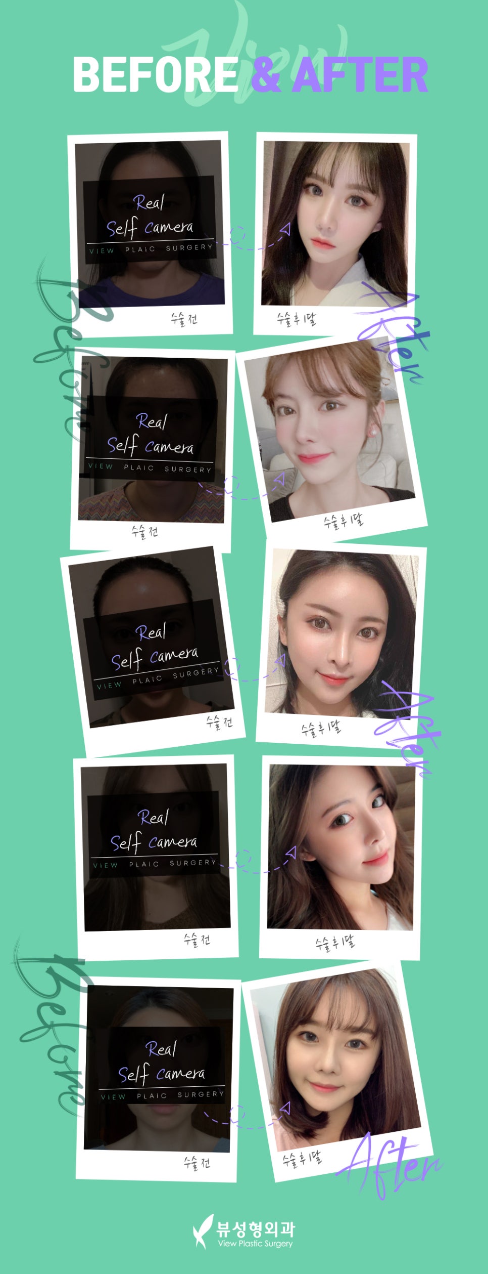 밋밋한 얼굴을 볼륨감 있게 입체적으로 개선하는 지방이식 관련 이미지 8