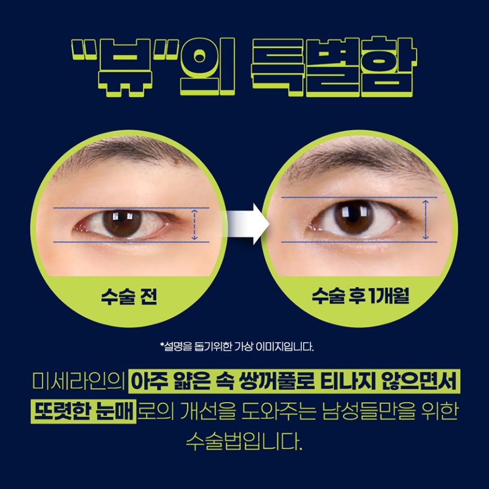 남자눈매교정 개인 상황에 맞춰 뷰에서 관련 이미지 2