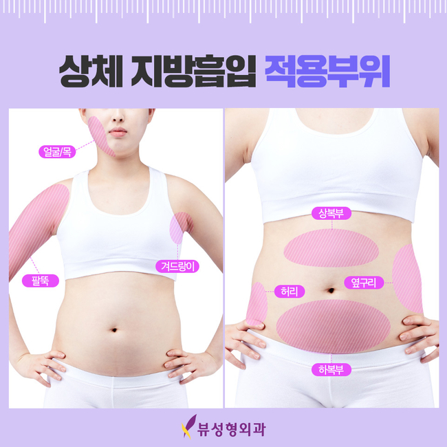 지방흡입수술로 워너비 몸매 만들어봐요~ 관련 이미지 3