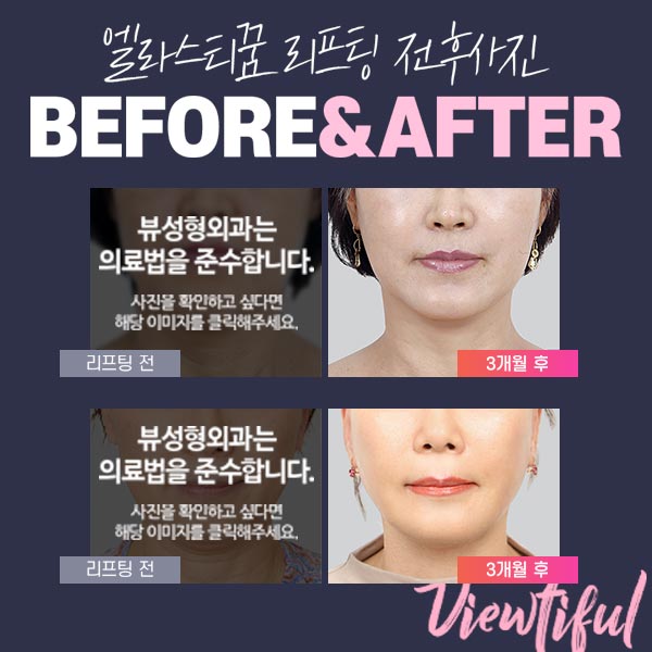 동안 얼굴의 비결! 엘라스티꿈 관련 이미지 7