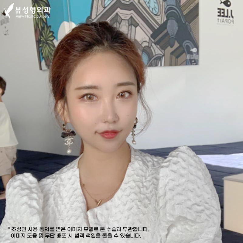 안면윤곽후기 뼈 상태를 위주로 관련 이미지 25