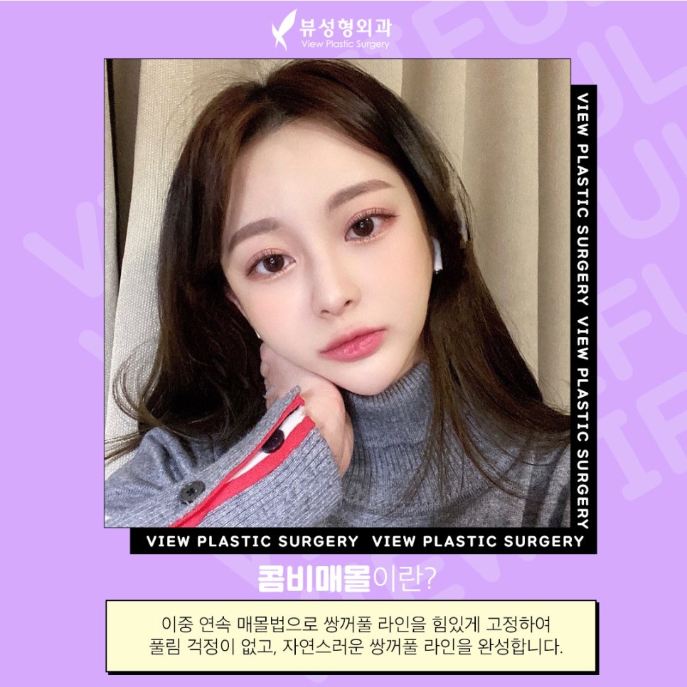 매몰법 잘 하는 곳 찾는다면 뷰 성형외과 관련 이미지 6