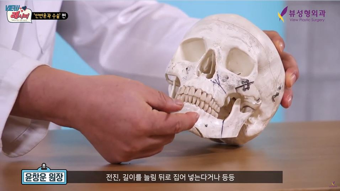 얼굴형의 밸런스를 맞춰주는 안면윤곽수술 관련 이미지 8